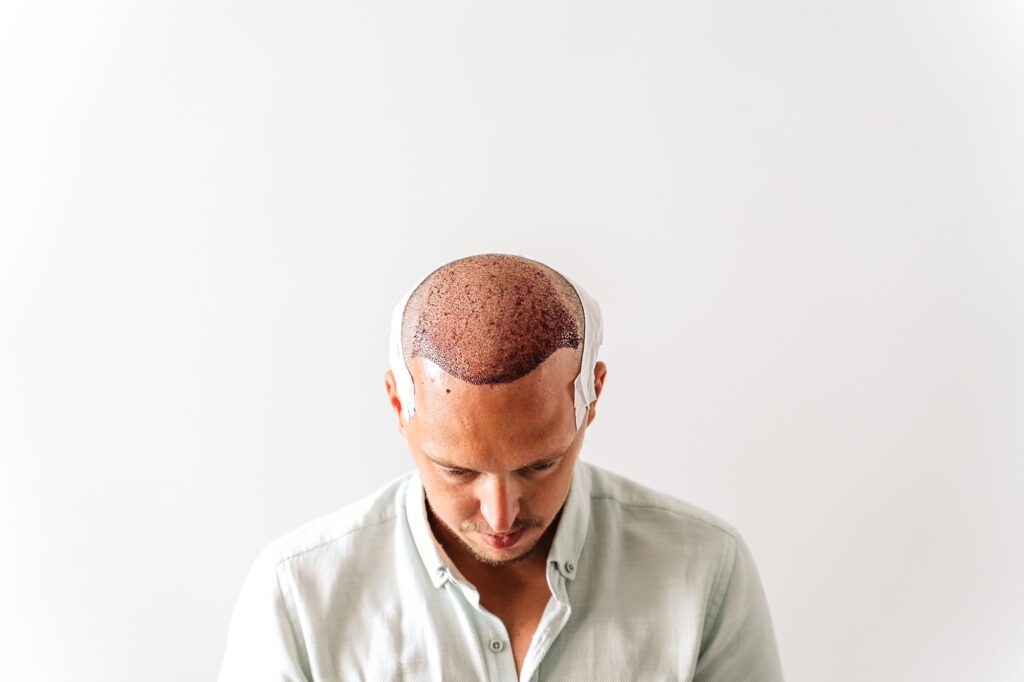 After hair transplantation surgical technique that moves hair follicles. Young bald man in bandage