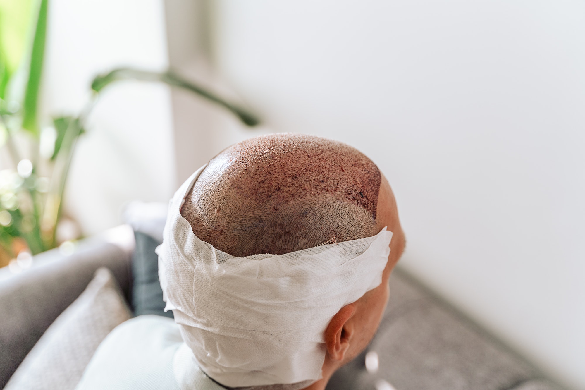 After hair transplantation surgical technique that moves hair follicles. Young bald man in bandage