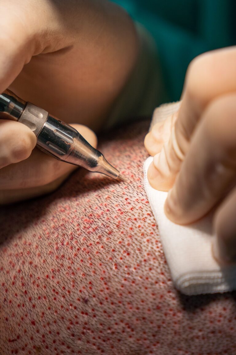Close up of hair surgeon hands extracting follicles with a circular scalpel called a punch.