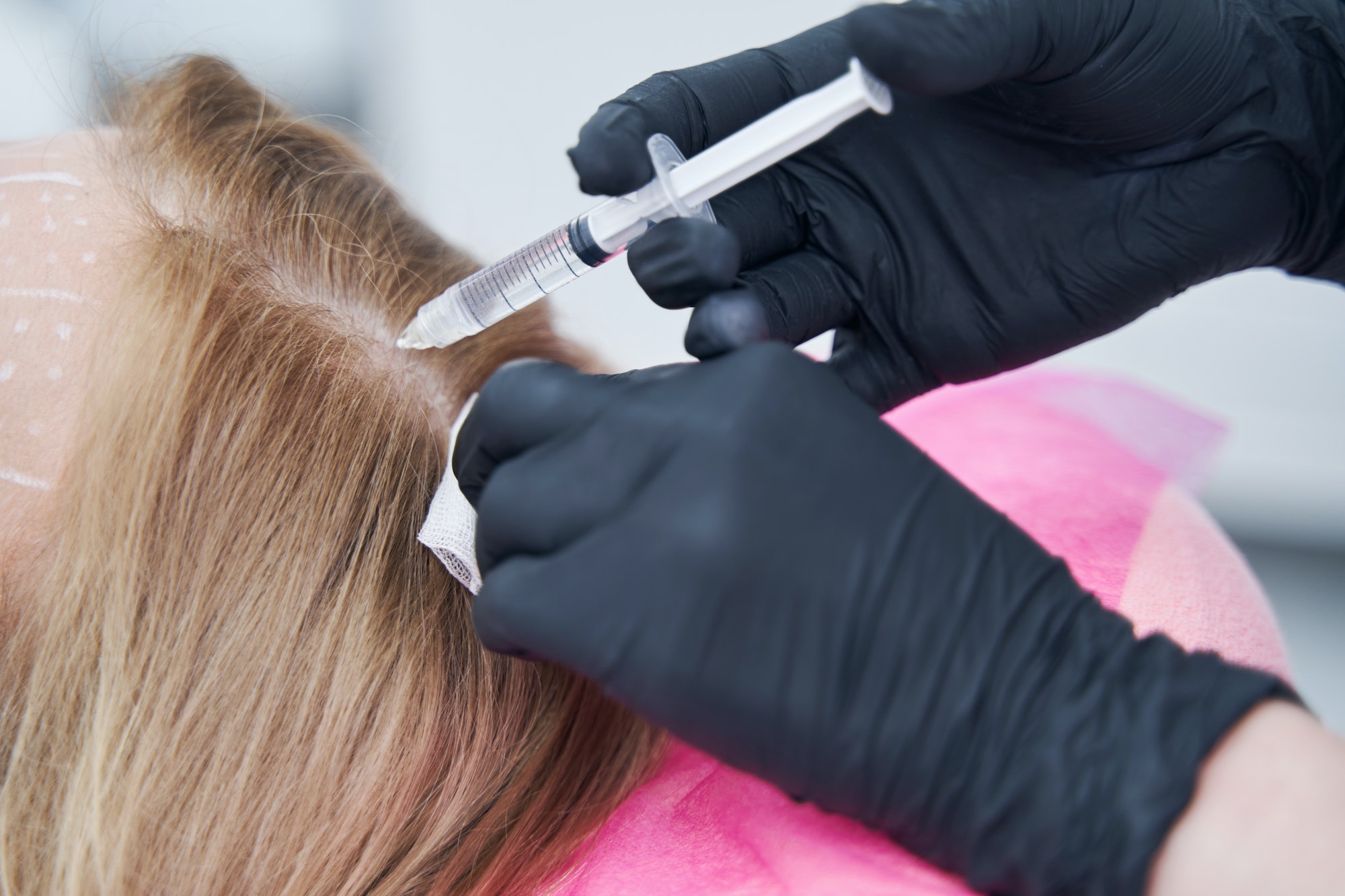Woman getting injection into scalp during mesotherapy